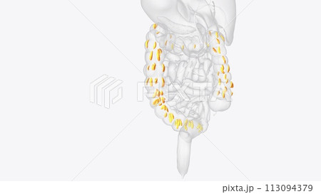 Epiploic appendages are normal outpouchings of peritoneal fat on the anti-mesenteric surface of the colon 113094379
