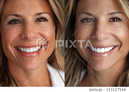 Smile Enhancement Comparison Smile Enhancement Comparison 113127544