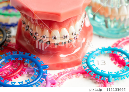 Orthodontic ligatures rings and ties, elastic rubber bands on orthodontic braces, model for dentist studying about dentistry. 113135665