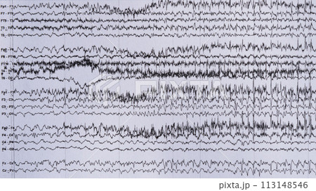 Imaging of ictal EEG recording in epilepsy patient. 113148546