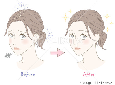 フケ　悩み　ビフォーアフター　女性　イラスト 113167692