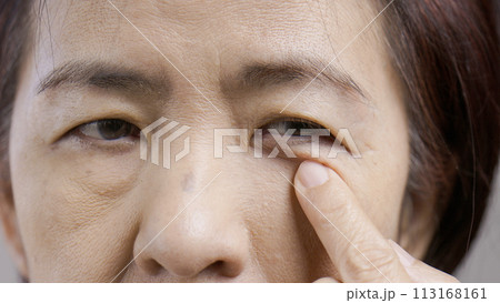 Senior asian woman worry about eye bags and dark spot. Senior asian woman worry about eye bags and dark spot. 113168161