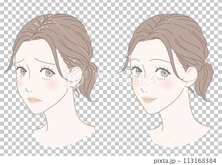 フケ　改善　女性　イラスト 113168384