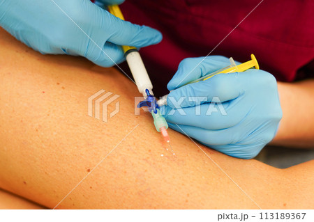 Removal of varicose veins on the legs. Doctor doing sclerotherapy Removal of varicose veins on the legs. Doctor doing sclerotherapy 113189367