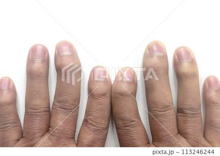 老人のへバーデン結節 113246244