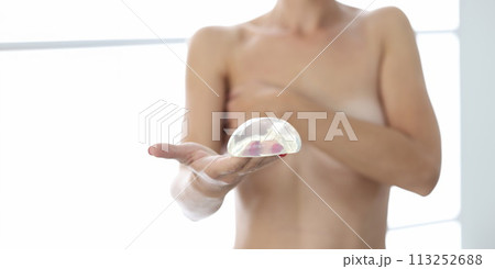 Nude female patient holds silicone breast implant in her hand 113252688