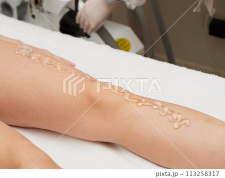 removing hair with laser treatment 113258317