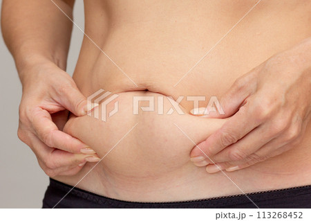 Hands on belly pressed skin to show sagging skin after diet and stretch marks after pregnancy 113268452