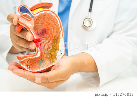 Stomach disease, doctor with anatomy model for study diagnosis and treatment in hospital. 113276815
