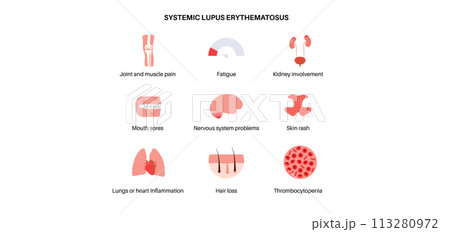 Systemic lupus erythematosus 113280972