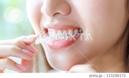 A woman puts on an invisible silicone aligner for her teeth. Bite Correction Braces Orthodontic Silicone Transparent Teeth Aligner 113288172