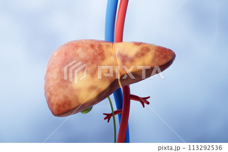 Liver organ with fatty liver state, 3d rendering. Liver organ with fatty liver state, 3d rendering. 113292536