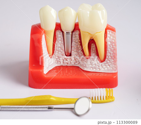 Dental implant, artificial tooth roots into jaw, root canal of dental treatment, gum disease, teeth model for dentist studying about dentistry. Dental implant, artificial tooth roots into jaw, root canal of dental treatment, gum disease, teeth model for dentist studying about dentistry. 113300089