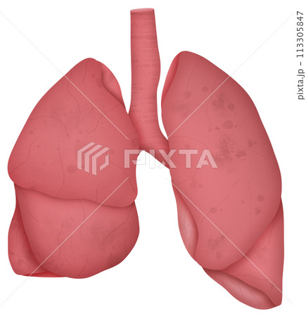 Lung 113305847