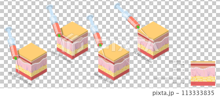 3D Isometric Flat  Conceptual Illustration of Injection Types 113333835