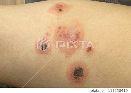Streptoderma on human skin close up. Strep Infectious disease Streptoderma on human skin close up. Strep Infectious disease 113358419