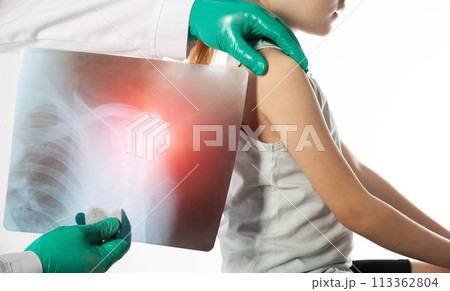 The hands of a doctor orthopedic traumatologist in green gloves holds an x-ray of a girl with a dislocated shoulder and a fracture of the shoulder. Trauma and sprain, close-up 113362804