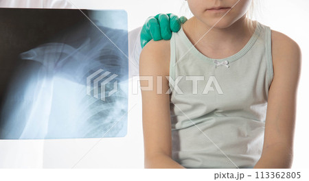 X-ray image of a doctor wearing green medical gloves against the background of a girl patient who has a shoulder injury. Dislocated shoulder, broken collarbone. Shoulder pain in children. Pediatric 113362805