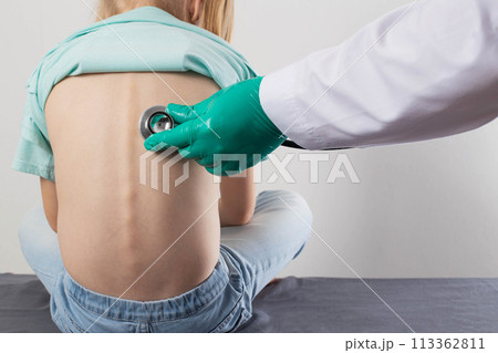 A doctor uses a stethoscope to listen to the lungs of a seven-year-old little girl. Concept of pneumonia, wheezing and bronchitis in children. Sputum discharge and cough. Treatment of viral and 113362811
