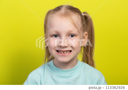 Portrait of a smiling seven-year-old girl with growing molars and falling out baby teeth. Defects of crooked teeth in the oral cavity. Children's dentistry, orthodontic 113362926