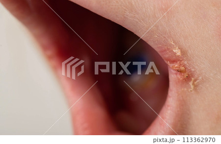 Seizures on the corners of the lips of a child s mouth. Bacterial disease of inflammation of the corners of the lips. Angular stomatitis with reduced immunity in a child, macro Seizures on the corners of the lips of a child s mouth. Bacterial disease of inflammation of the corners of the lips. Angular stomatitis with reduced immunity in a child, macro 113362970