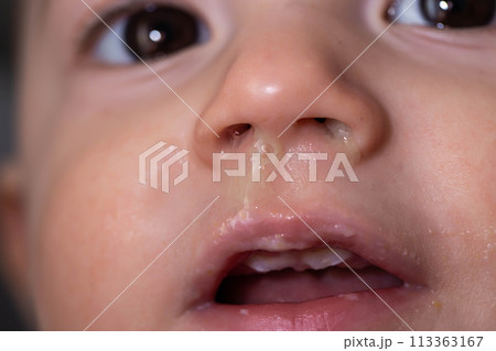 Face of a smiling baby boy with snot from his nose. Runny nose and nasal congestion in children. Virus and bacterial infection, close-up 113363167