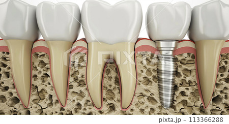 Dental implantation. Jaw bones and healthy teeth, screw and implant abutment. Dentistry and orthodontics Dental implantation. Jaw bones and healthy teeth, screw and implant abutment. Dentistry and orthodontics 113366288