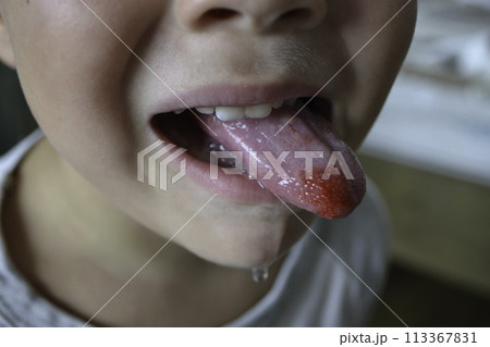 Close-up of lips, tongue, protrusion of blood. Child's bitten tongue. High quality photo 113367831