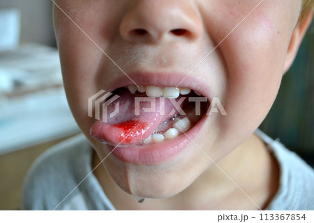 Child's bitten tongue. Close-up of lips, tongue, protrusion of blood Child's bitten tongue. Close-up of lips, tongue, protrusion of blood 113367854