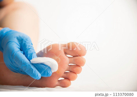 Treatment of a callus on the foot with a special solution after surgery to remove the callus and wart. Copy space for text 113370080