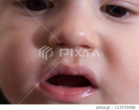 Bacterial diseases in the nose. Yellow snot from the nose of a little boy. Colds and infectious diseases, allergies. Close-up 113370486