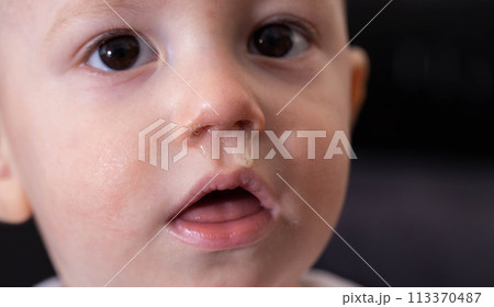 Bacterial diseases in the nose. Yellow snot from the nose of a little boy. Colds and infectious diseases, allergies. Close-up 113370487