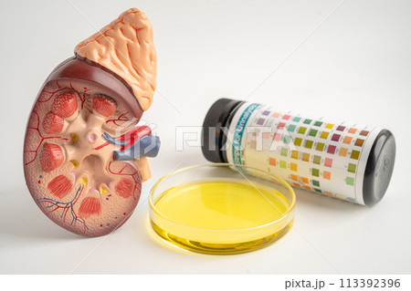 Urinalysis, Kidney model and urine cup with reagent strip pH paper test and comparison chart in laboratory. Urinalysis, Kidney model and urine cup with reagent strip pH paper test and comparison chart in laboratory. 113392396