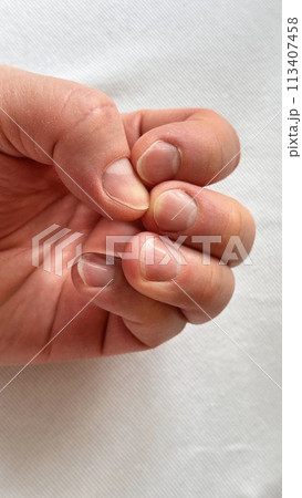 A man's hand with long uncut damaged nails. Unkempt nails of a man on a white background. Close-up A man's hand with long uncut damaged nails. Unkempt nails of a man on a white background. Close-up 113407458