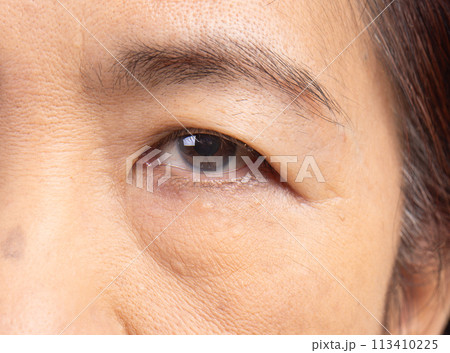 Flabby and wrinkled skin on senior woman face. Flabby and wrinkled skin on senior woman face. 113410225