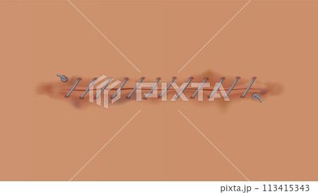 Healing wounds, skin scar, stitched gash and cut. Realistic surgical suture, stitched wounds. Healing stage on human skin background. Vector illustration 113415343