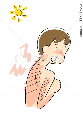 日焼けした背中が痛い男性 日焼けした背中が痛い男性 113417508