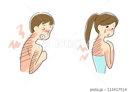 日焼けした背中が痛む男性と女性 113417514