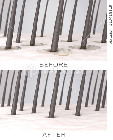 Oily and normal hair. Excessive secretion of sebum from the hair follicles. Sebaceous gland overproduction of oil. Skin pores fill up with sebum around the hair follicles and the scalp gets greasy 113418119