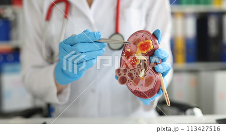 Urology and treatment of kidney diseases closeup Urology and treatment of kidney diseases closeup 113427516