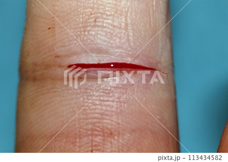 指の切り傷 113434582