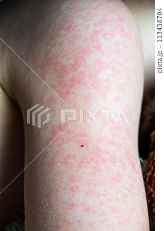 Viral disease. Measles rash on the body of the child. Allergy 113438704