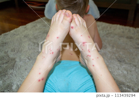 Natural vaccination. Contagious disease. Natural vaccination. Contagious disease. 113439294