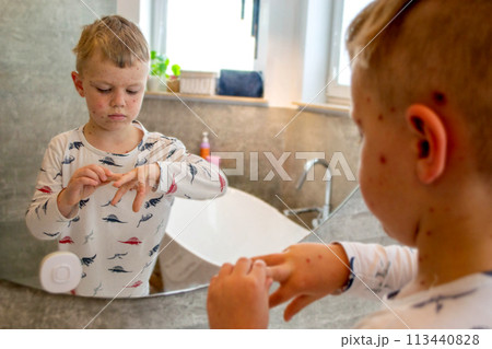 Varicella virus or Chickenpox bubble rash on child Varicella virus or Chickenpox bubble rash on child 113440828