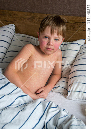 Viral disease. Measles rash on the body of the child. Allergy Viral disease. Measles rash on the body of the child. Allergy 113440873