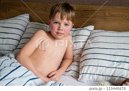 Viral disease. Measles rash on the body of the child. Allergy 113440878