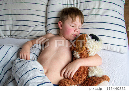 Viral disease. Measles rash on the body of the child. Allergy 113440881