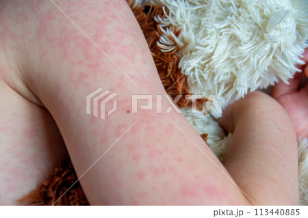 Viral disease. Measles rash on the body of the child. Allergy Viral disease. Measles rash on the body of the child. Allergy 113440885