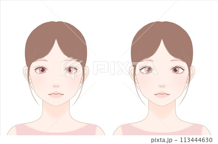 目尻切開の整形のBeforeとAfter 目尻切開の整形のBeforeとAfter 113444630