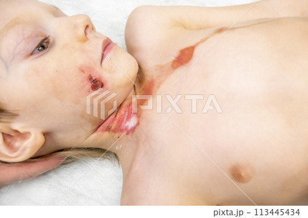 dressing a boy with a burn from boiling water 113445434